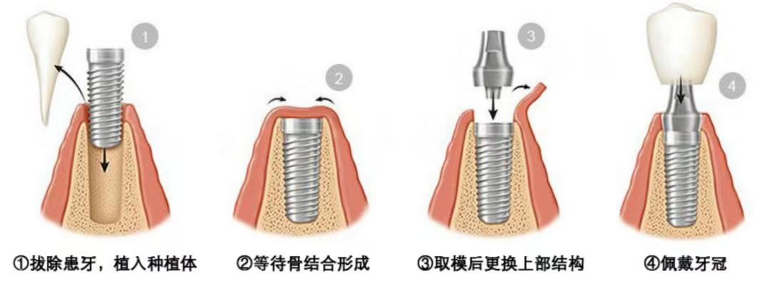 相比于可摘局部义齿